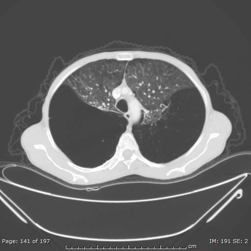 Alpha-1-antitrypsin deficiency (Radiopaedia 50561-55987 Axial lung window 59).jpg
