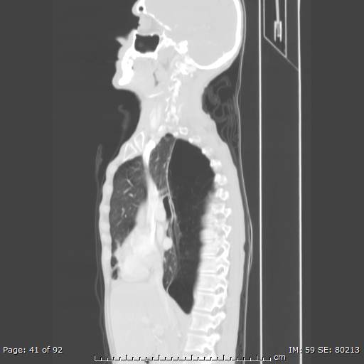File:Alpha-1-antitrypsin deficiency (Radiopaedia 50561-55987 Sagittal lung window 20).jpg