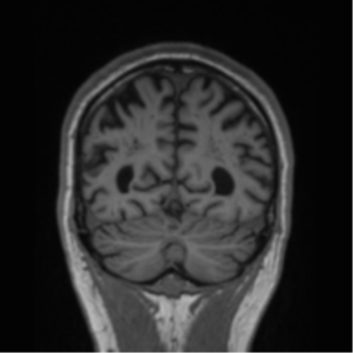 Alzheimer's disease- with Gerstmann syndrome and dressing apraxia (Radiopaedia 54882-61150 Coronal T1 21).png