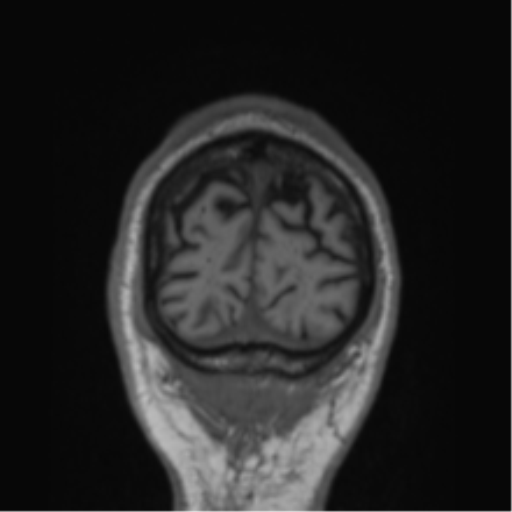 Alzheimer's disease- with Gerstmann syndrome and dressing apraxia (Radiopaedia 54882-61150 Coronal T1 8).png
