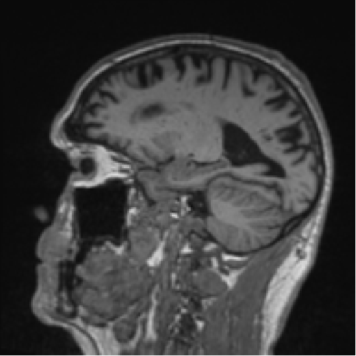 Alzheimer's disease- with Gerstmann syndrome and dressing apraxia (Radiopaedia 54882-61150 Sagittal T1 23).png