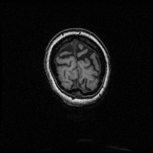 Alzheimer's disease (Radiopaedia 30244-30872 Coronal T1 12).jpg