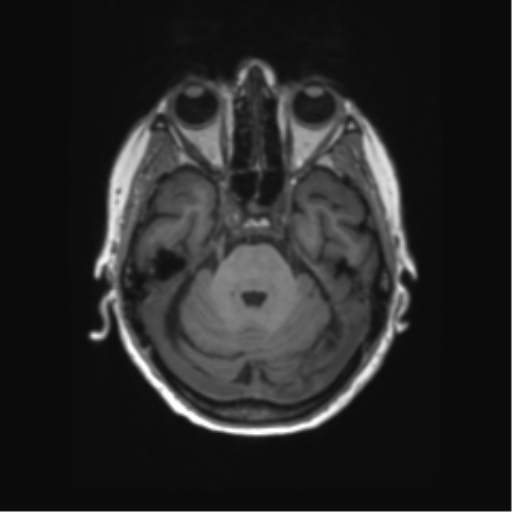 File:Alzheimer's disease (Radiopaedia 42658-45802 Axial T1 109).png
