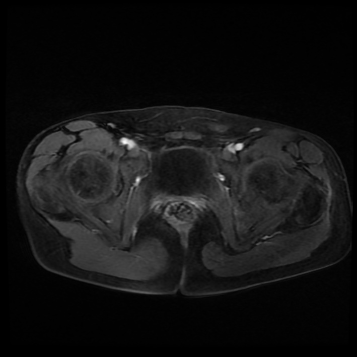 Ambiguous genitalia (Radiopaedia 69686-79643 Axial T1 C+ fat sat 38).jpg