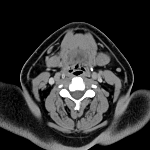 Ameloblastoma (Radiopaedia 38520-40623 Axial non-contrast 41).png