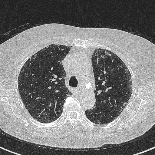 Amiodarone-induced pulmonary fibrosis (Radiopaedia 82355-96460 Axial lung window 24).jpg
