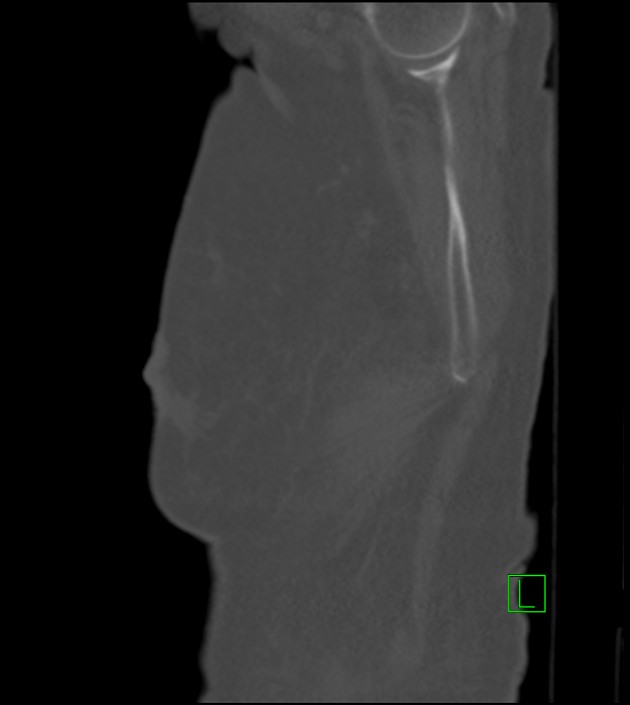 Amiodarone deposition in the liver (Radiopaedia 77587-89780 Sagittal bone window 91).jpg
