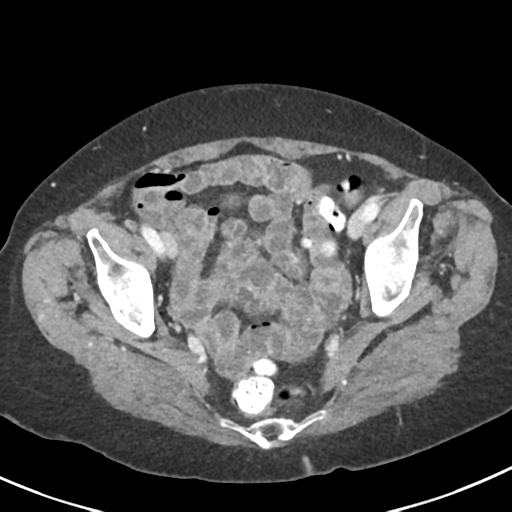 Ampullary adenocarcinoma (Radiopaedia 34013-35237 C 48).png