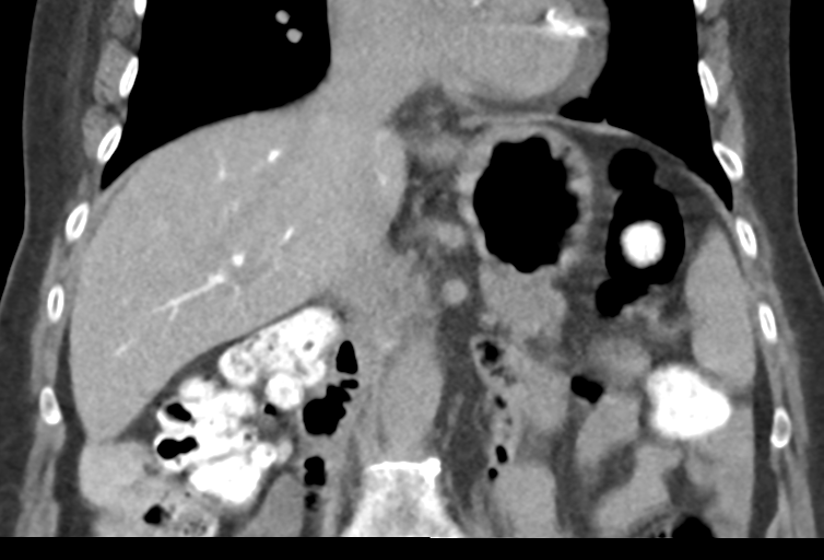 Ampullary adenocarcinoma (Radiopaedia 34013-35241 Coronal 25).png