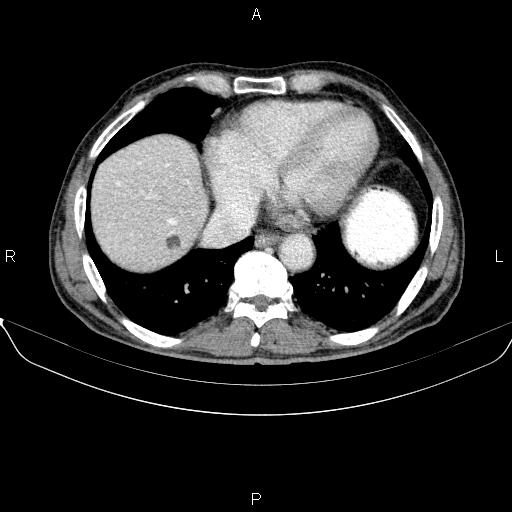 Ampullary adenocarcinoma (Radiopaedia 86093-102032 A 7).jpg