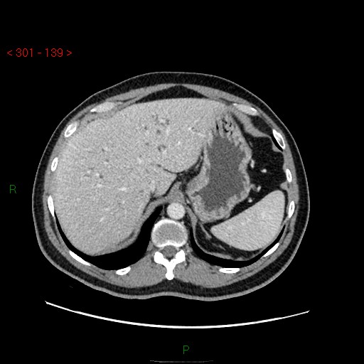 Ampullary carcinoma (Radiopaedia 56396-63056 C 20).jpg