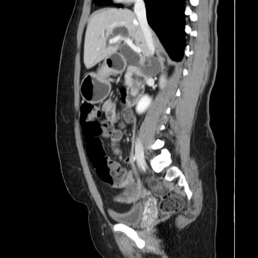 Ampullary tumor (Radiopaedia 22787-22816 D 24).jpg