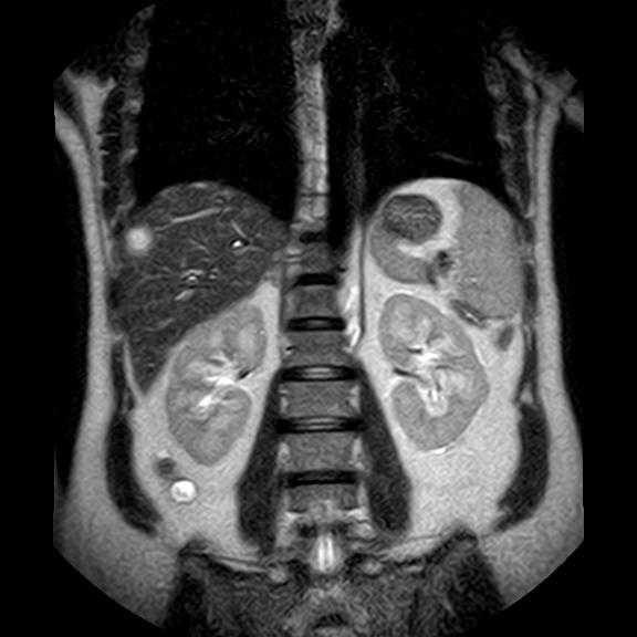 File:Ampullary tumor (Radiopaedia 27294-27479 Coronal T2 18).jpg