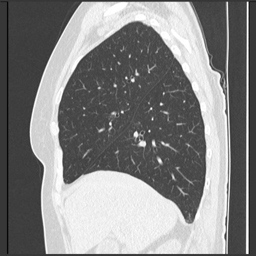 File:Amyloidosis - bronchial and diffuse nodular pulmonary involvement (Radiopaedia 60156-67744 F 17).jpg