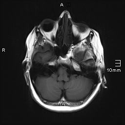 File:Amyotrophic lateral sclerosis (Radiopaedia 70821-81017 Axial T1 7).jpg