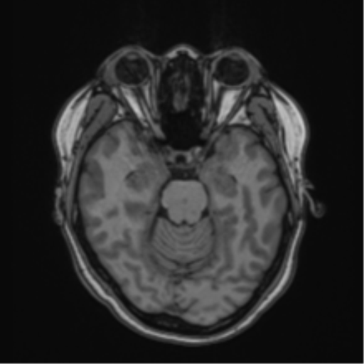 Anaplastic astroblastoma (Radiopaedia 55666-62194 Axial T1 27).png