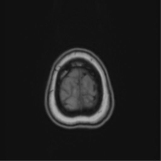 Anaplastic astroblastoma (Radiopaedia 55666-62194 Axial T1 70).png
