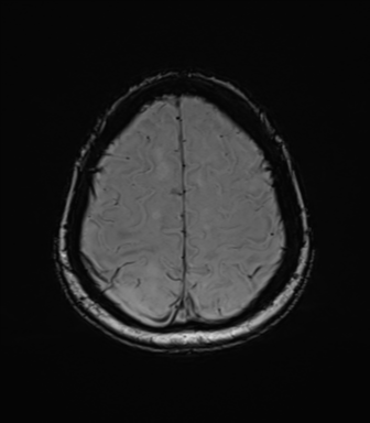 Anaplastic astrocytoma (Radiopaedia 86943-103160 Axial SWI 73).png