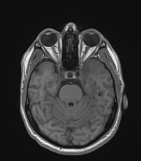 Anaplastic astrocytoma IDH wild-type (Radiopaedia 49984-55273 Axial T1 20).png