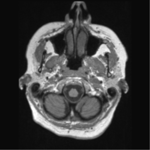 Anaplastic astrocytoma IDH wild-type (pseudoprogression) (Radiopaedia 42209-45276 Axial T1 20).png
