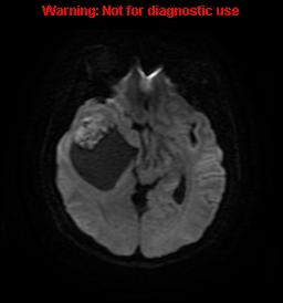 File:Anaplastic ganglioglioma (Radiopaedia 44921-48831 Axial DWI 12).jpg