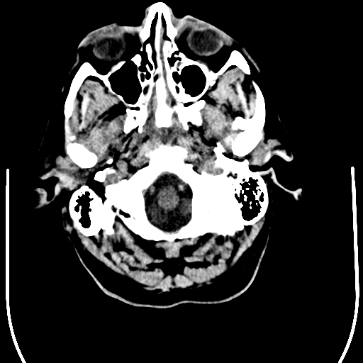 File:Anaplastic meningioma with recurrence (Radiopaedia 34452-35781 Axial non-contrast 3).png