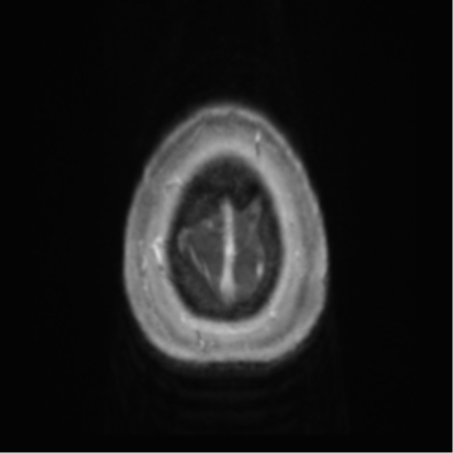 Anaplastic oligodendroglioma (Radiopaedia 83500-98599 Axial T1 C+ 73).png