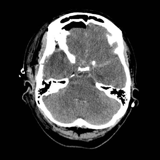 Aneursym related subarachnoid hemorrhage with hydrocephalus (Radiopaedia 45105-49085 Axial non-contrast 12).jpg