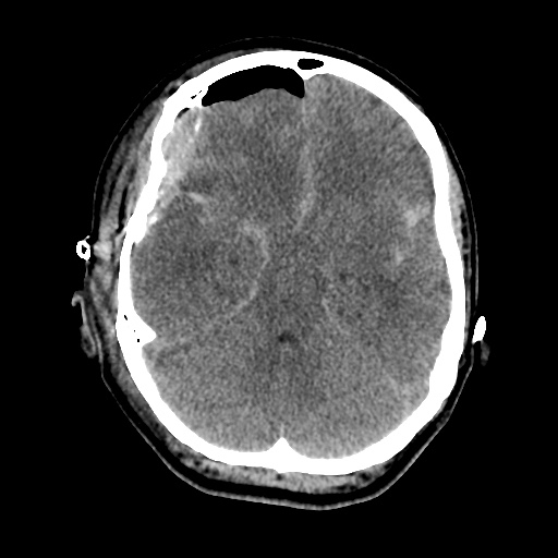 Aneursym related subarachnoid hemorrhage with hydrocephalus (Radiopaedia 45105-49085 Axial non-contrast 17).jpg