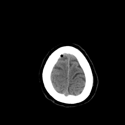 Aneursym related subarachnoid hemorrhage with hydrocephalus (Radiopaedia 45105-49085 Axial non-contrast 47).jpg