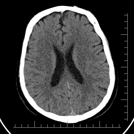 Aneurysm of posterior communicating artery (Radiopaedia 20188-20162 Axial non-contrast 30).jpg