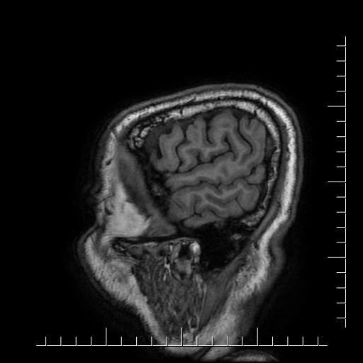 File:Aneurysm of posterior communicating artery (Radiopaedia 20188-20163 Sagittal T1 6).jpg