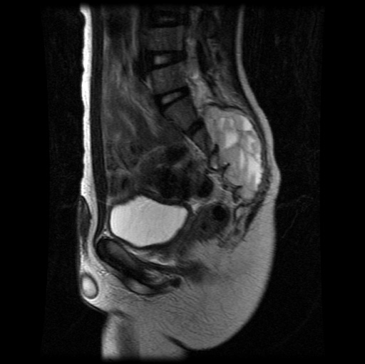 File:Aneurysmal bone cyst - sacrum (Radiopaedia 65190-74196 Sagittal T2 15).jpg