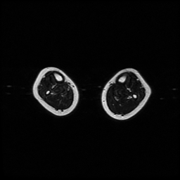 File:Aneurysmal bone cyst - tibia (Radiopaedia 22343-22367 Axial T2 1).jpg