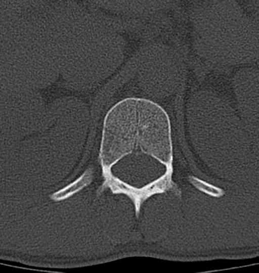 Aneurysmal bone cyst T11 (Radiopaedia 29294-29721 Axial bone window 54).jpg