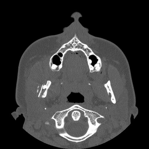 Aneurysmal bone cyst of the mandible (Radiopaedia 43280-46823 Axial bone window 95).jpg