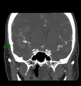 Aneurysmal subarachnoid hemorrhage with intra-axial extension (Radiopaedia 84371-99732 C 61).jpg