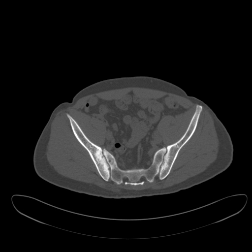 Ankylosing spondylitis (Radiopaedia 52728-58645 Axial bone window 40).jpg