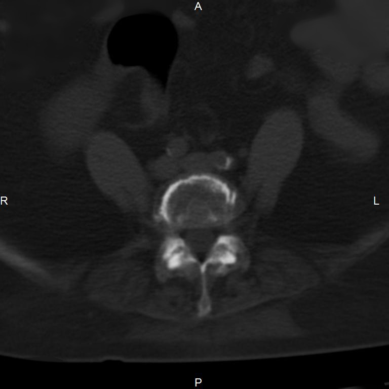 Ankylosing spondylitis (Radiopaedia 8748-9556 Axial bone window 42).jpg