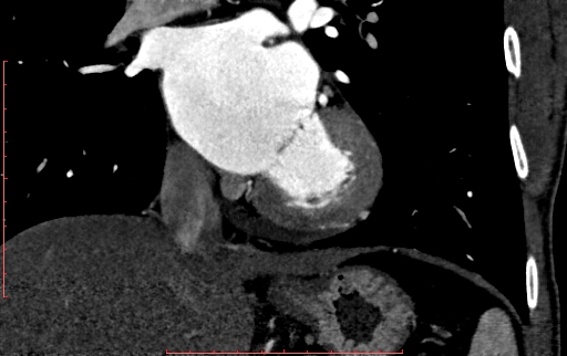 Anomalous left coronary artery from the pulmonary artery (ALCAPA) (Radiopaedia 70148-80181 B 192).jpg