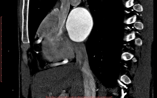 File:Anomalous left coronary artery from the pulmonary artery (ALCAPA) (Radiopaedia 70148-80181 C 59).jpg