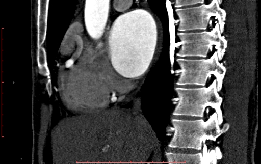 File:Anomalous left coronary artery from the pulmonary artery (ALCAPA) (Radiopaedia 70148-80181 C 81).jpg