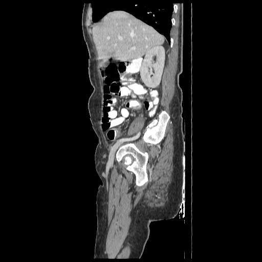 File:Anorectal carcinoma (Radiopaedia 44413-48064 C 26).jpg