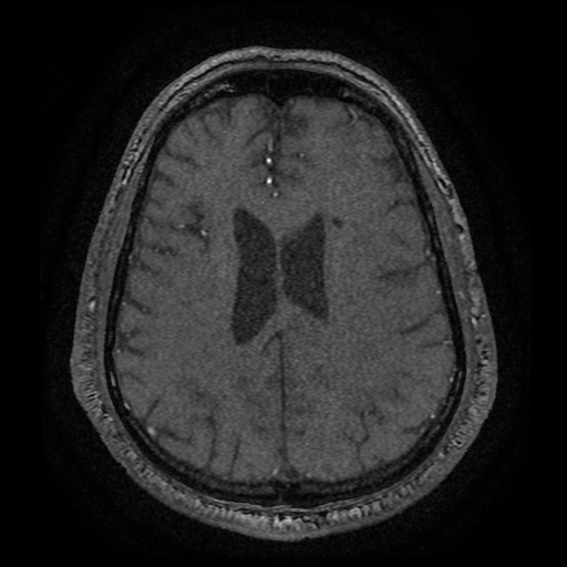 Anterior cerebral artery infarction (Radiopaedia 46794-51323 Axial MRA 154).jpg
