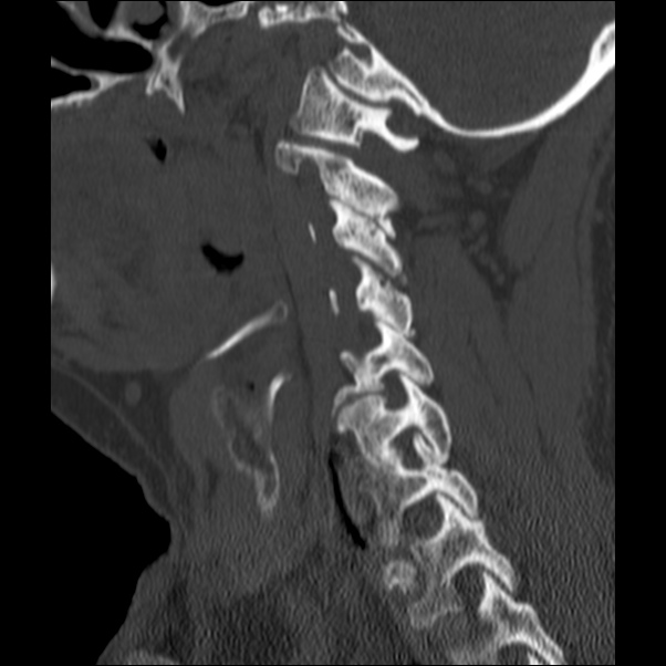 Anterior cervical postdiscectomy arthrodesis (Radiopaedia 32678-33646 Sagittal bone window 53).jpg