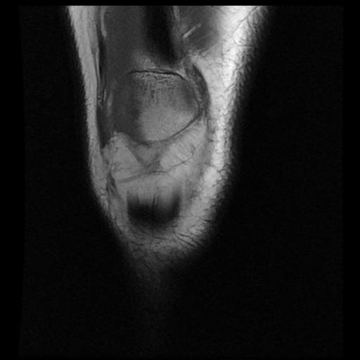 File:Anterior cruciate ligament avulsion fracture (Radiopaedia 58939-66193 Coronal T1 3).jpg