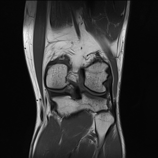 File:Anterior cruciate ligament full thickness tear (Radiopaedia 66268-75467 Coronal T1 14).jpg