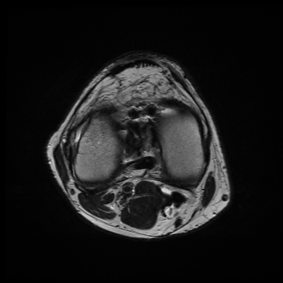 File:Anterior cruciate ligament graft tear and bucket-handle tear of medial meniscus (Radiopaedia 75867-87254 Axial T2 11).jpg