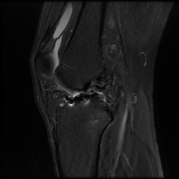 File:Anterior cruciate ligament graft tear and bucket-handle tear of medial meniscus (Radiopaedia 75867-87254 Sagittal PD fat sat 15).jpg