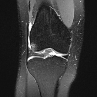 File:Anterior cruciate ligament rupture and posteromedial corner injury (Radiopaedia 67338-76723 Coronal PD fat sat 17).jpg